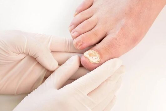 Doctors recommend a brand fungent brand for mikoza treatment