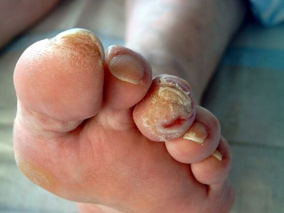 Diabetic feet and onychomycosis