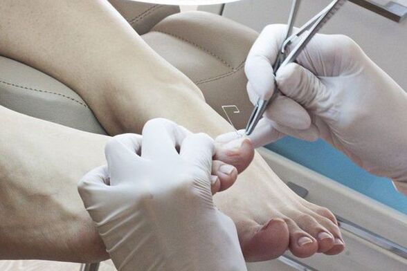 Mechanical removal of nails affected by fungi