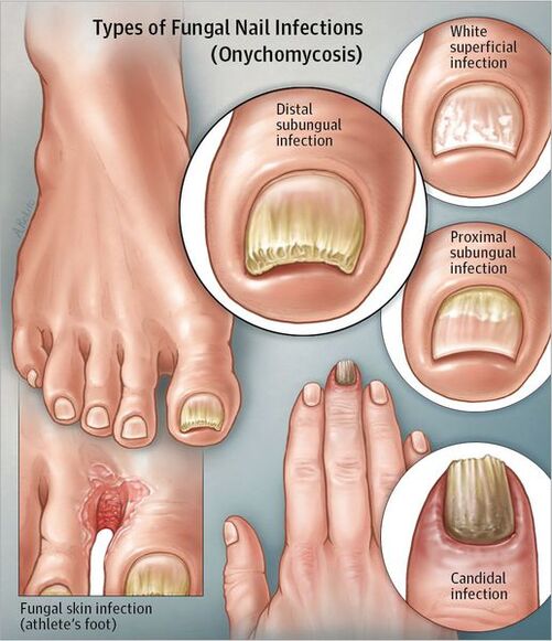 Types of onynxism
