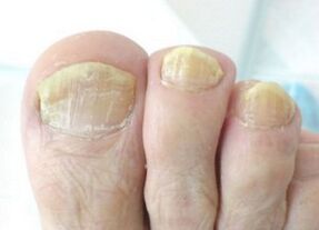 Fungus nail