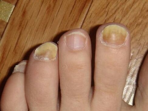 Foot fungus with nail damage